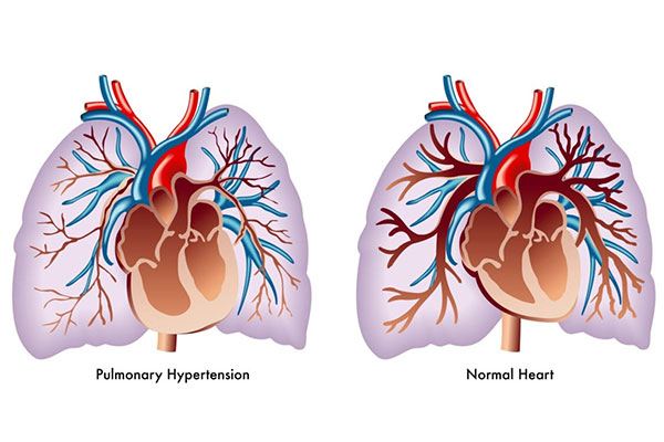 Treatment of pulmonary hypertension